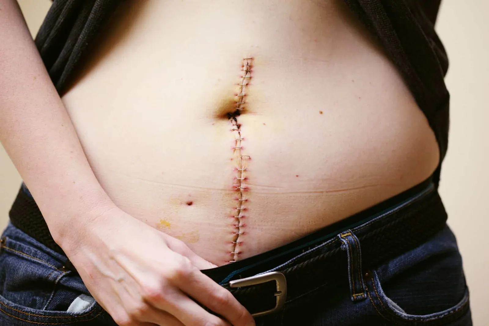 Fil résorbable qui ressort de la cicatrice : comprendre et gérer cette étape de guérison